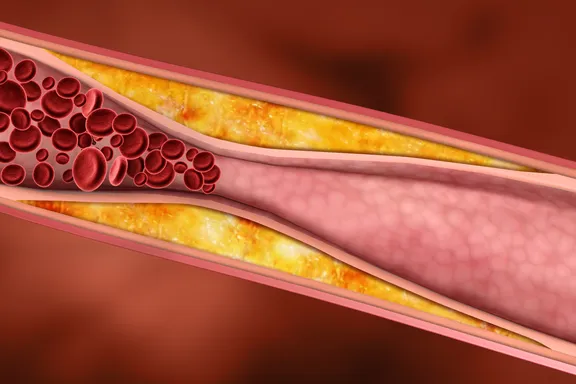 The Truth About Cholesterol 