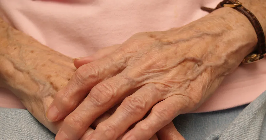 Study Says Rheumatoid Arthritis Linked To Blood Clots: Overall Risk Is Small But Present