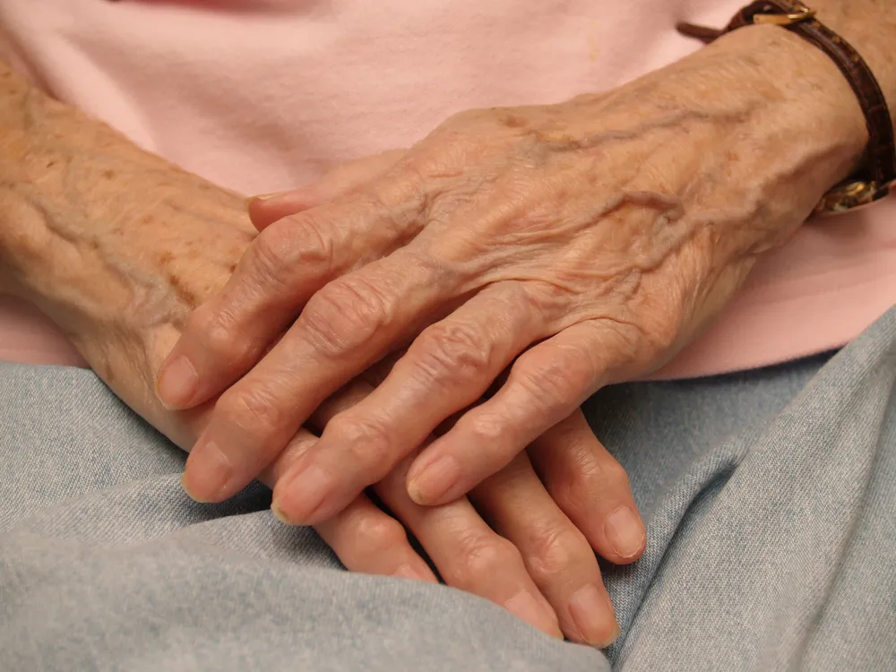 Study Says Rheumatoid Arthritis Linked To Blood Clots: Overall Risk Is Small But Present