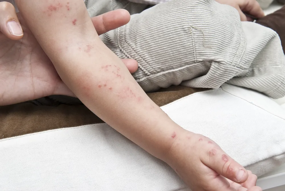 Is It Chicken Pox, Or Could It Be Foot And Mouth Disease?