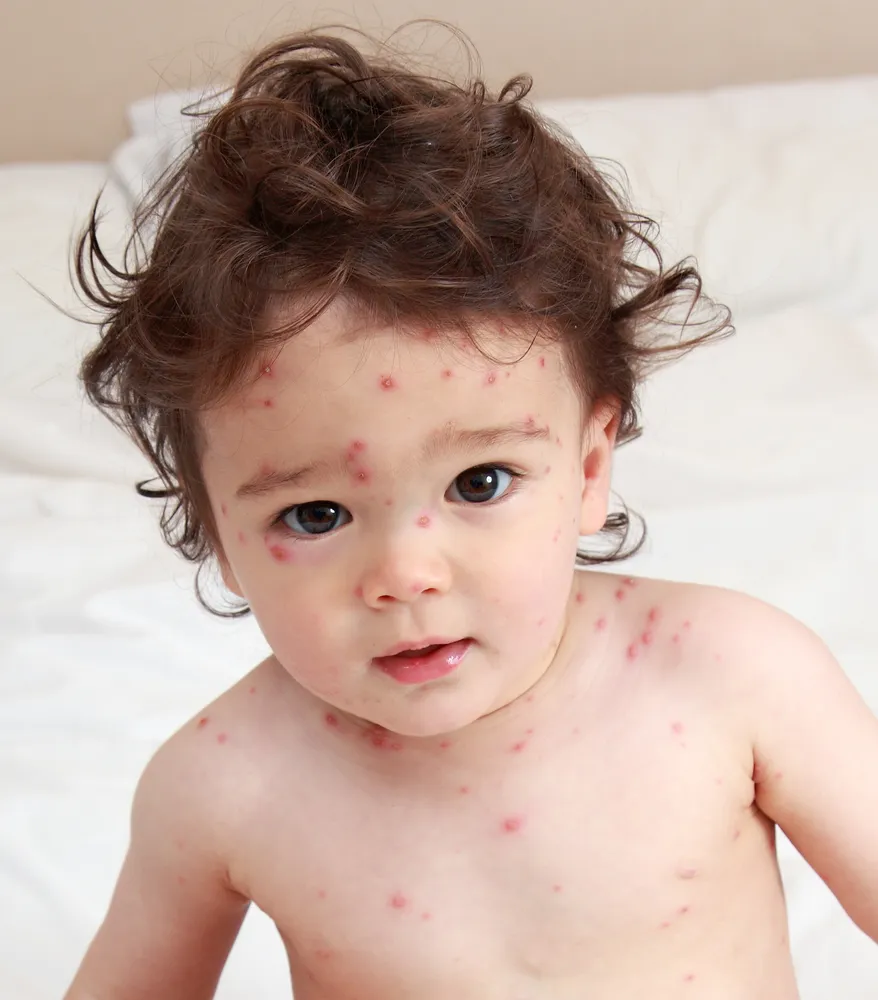 Varicelle : 8 signes de la varicelle