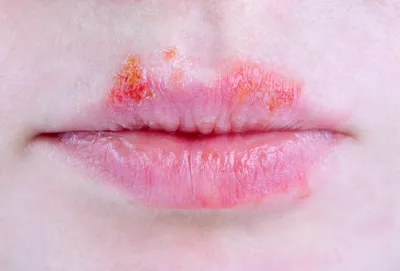 Cold Sores