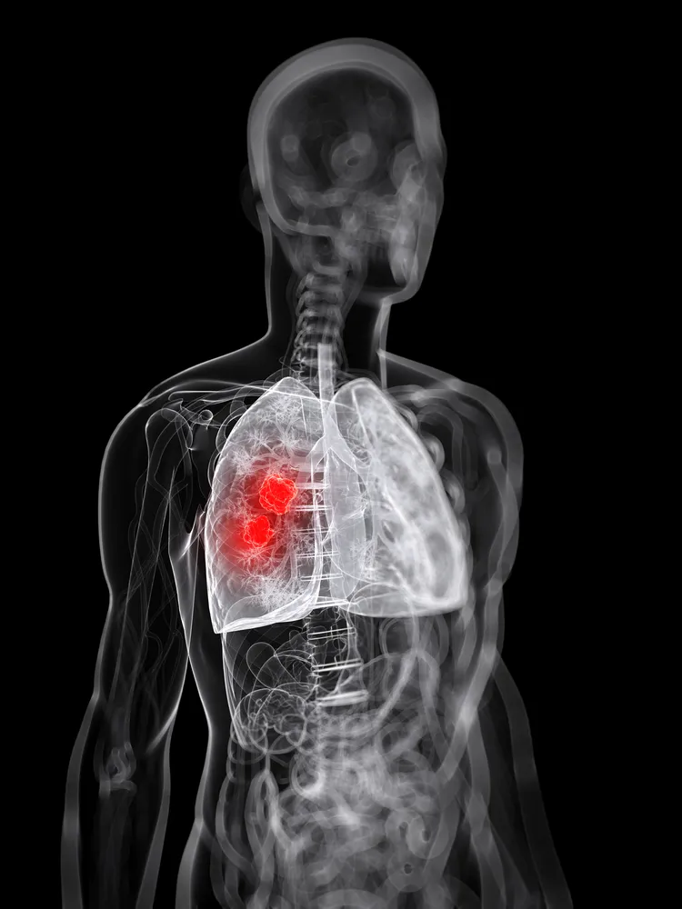 10 Warnsignale bei Lungenkrebs