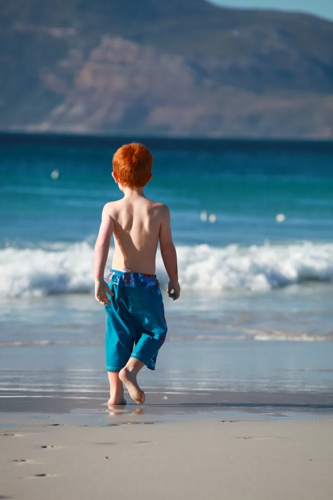 Red Heads May be Genetically Predisposed to Melanoma