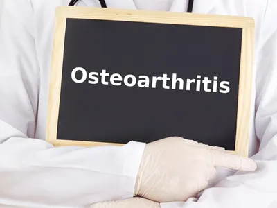 Osteoarthritis