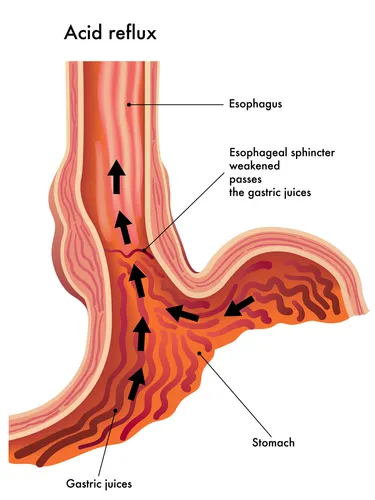 What is Gerd?