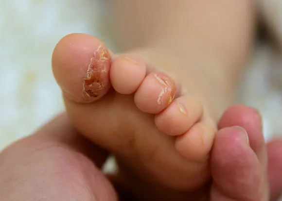 Probiotics Reduce Problem Skin for Infants