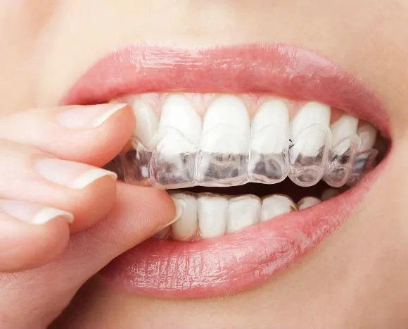The Unknown Dangers of Teeth Whitening