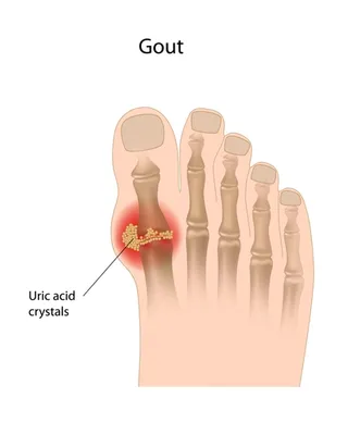 Gout