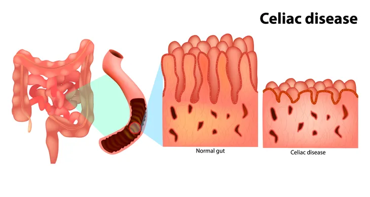 Causes of Left Lower Quadrant Pain in Men and Women – ActiveBeat – Your  Daily Dose of Health Headlines