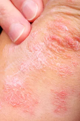 Dyshidrotic Eczema