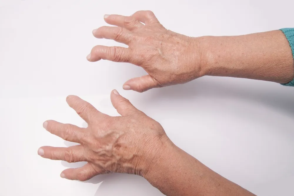 10 Rimedi Naturali per l’Artrite Reumatoide