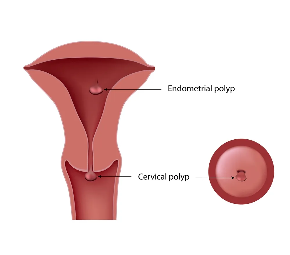 10 Warnsignale bei Gebärmutterhalskrebs