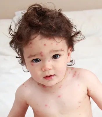 chicken pox