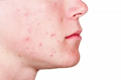 acne breakout skin