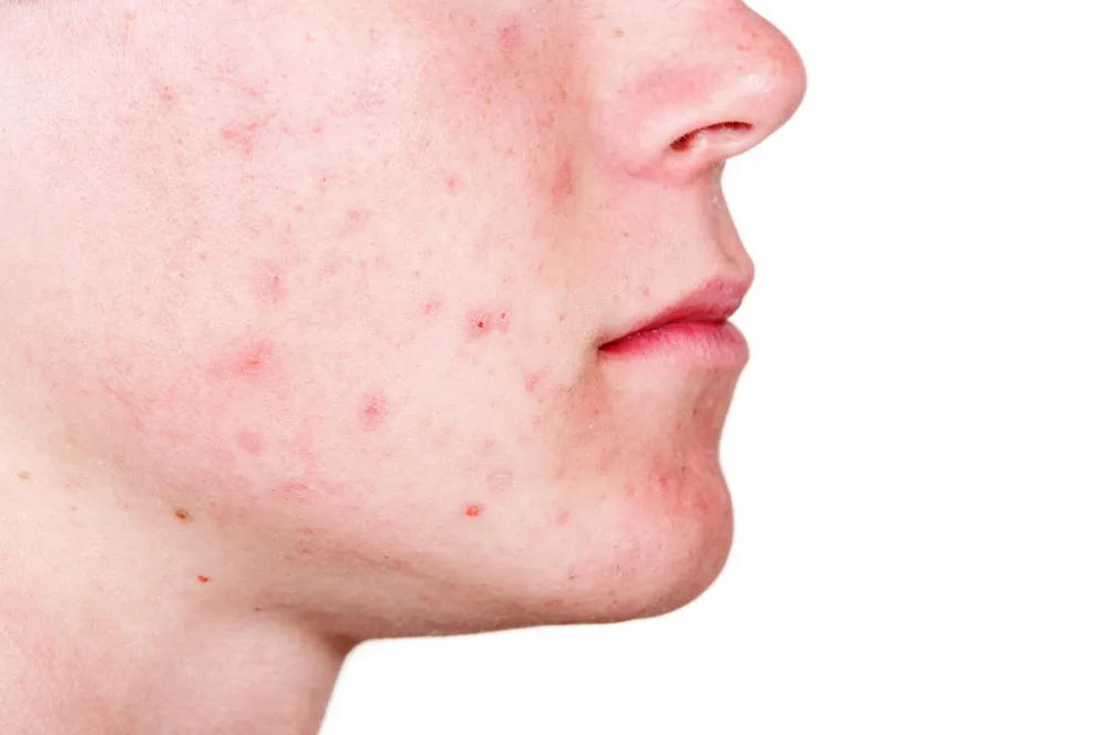 10 tratamientos caseros eficaces para el acné