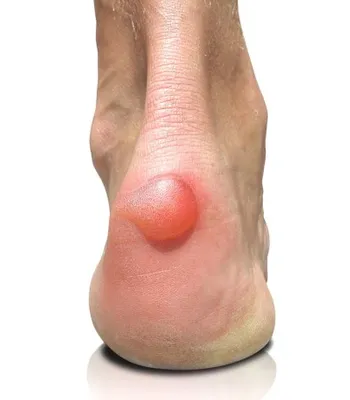 blister 4