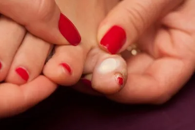 blister 3