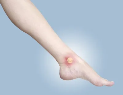 elevate blister