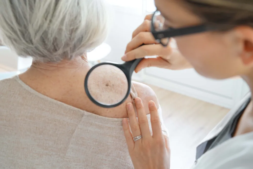 Signes que votre grain de beauté pourrait être cancéreux