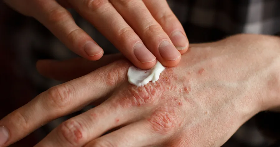 Must-Have Lotions for Treating Psoriasis