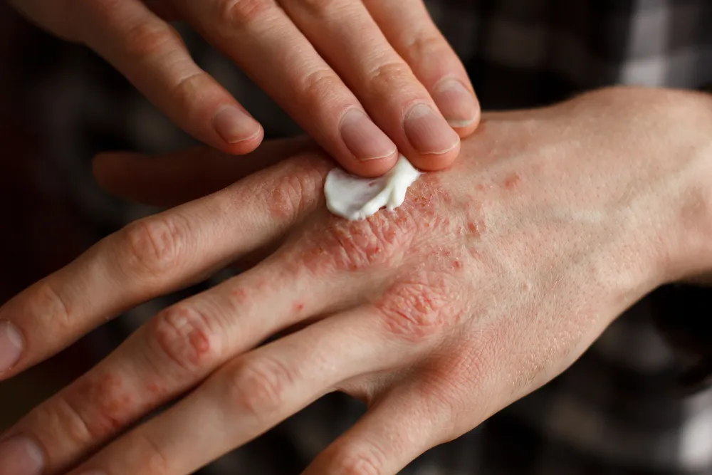 A Complete Guide To Living With Psoriasis