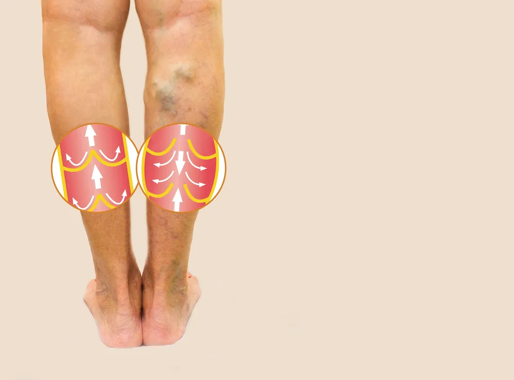 Deep Vein Thrombosis Symptoms: Do You Have DVT?