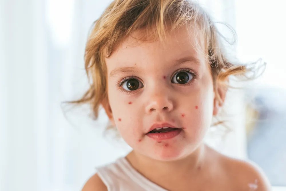 Chicken Pox: Common Signs of Chickenpox