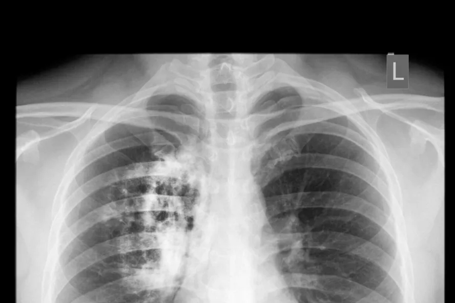 11 Signes Que Vous Pourriez Avoir Une Maladie Pulmonaire Obstructive Chronique