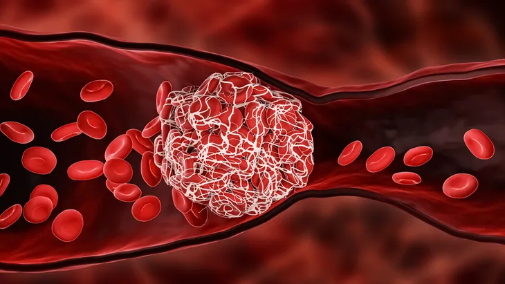 Common Blood Clot Myths, Debunked – ActiveBeat – Your Daily Dose of Health  Headlines