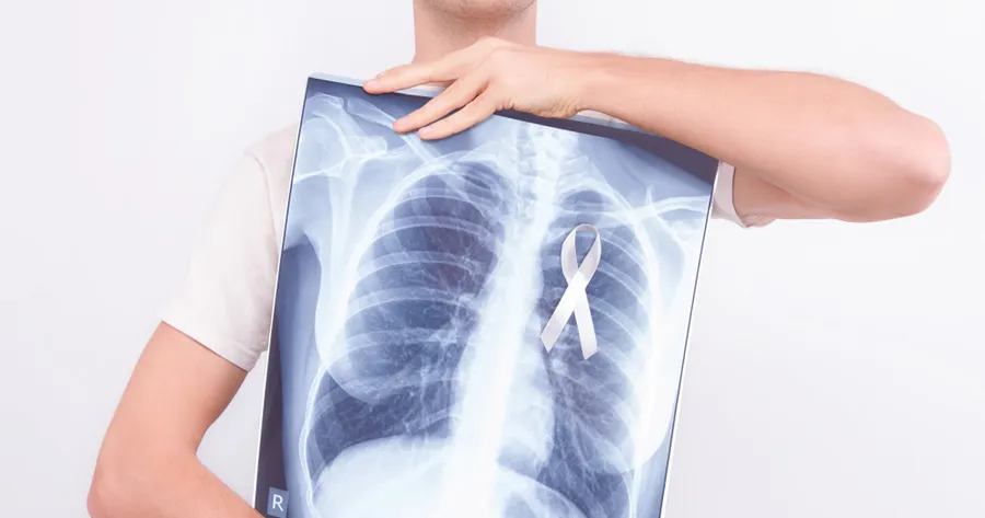 Lung Cancer: 22 Early Signs and Symptoms