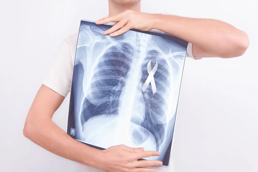 Cancer du poumon : premiers signes et symptômes