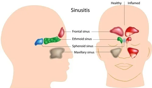 6 Signs of a Sinus Infection - Montgomery County ENT Institute