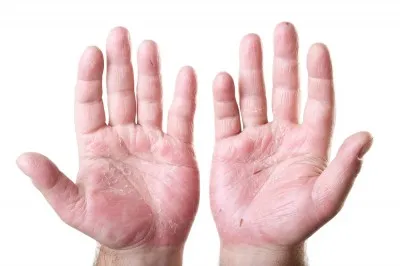 swollen hands