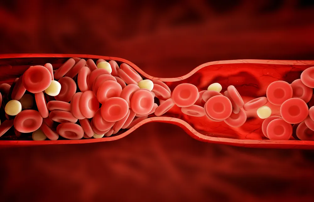 Señales y síntomas comunes de un coágulo de sangre