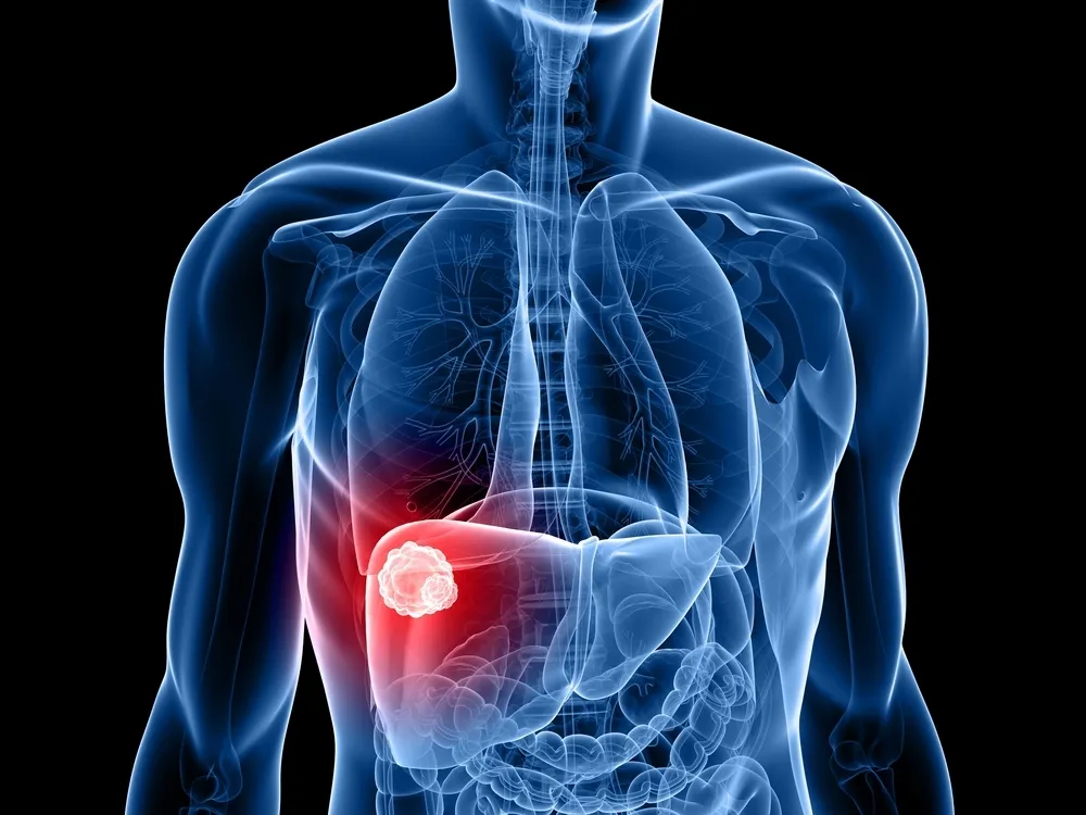 Die Symptome und Hauptursachen von Leberkrebs