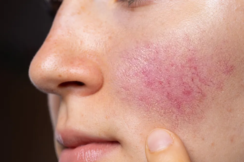 Common Symptoms of Rosacea