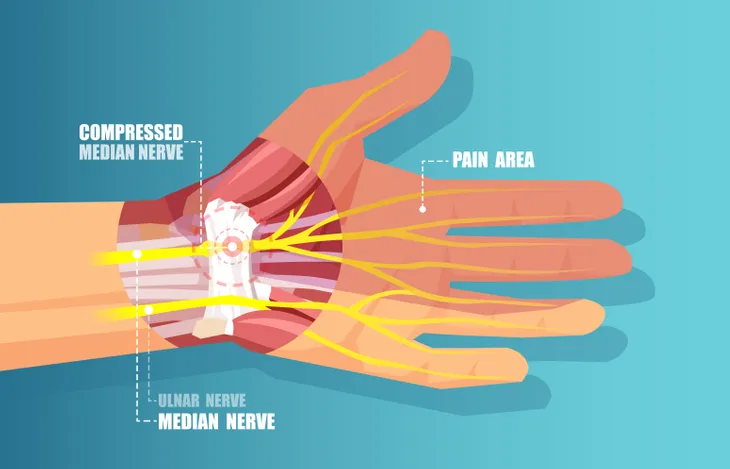 Feeling a Tingling Sensation in Your Hand or Wrist That Won't Go Away? It  Could Be a Sign of Carpal Tunnel Syndrome