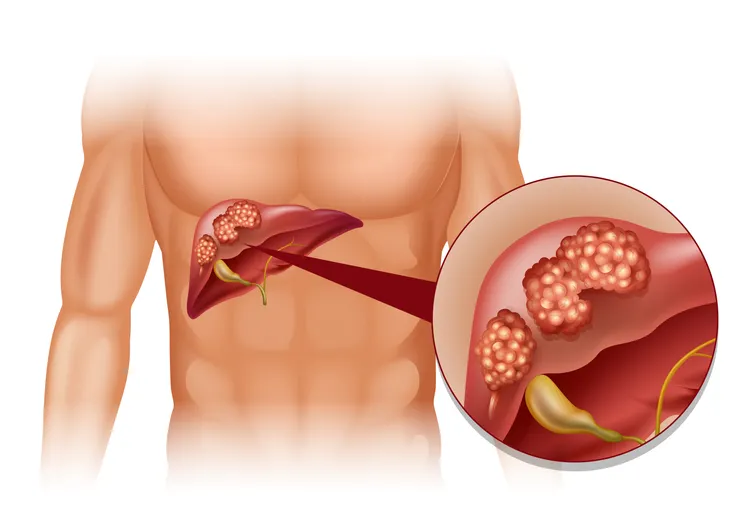 11 Signs and Symptoms of a Kidney Infection – ActiveBeat – Your Daily Dose  of Health Headlines