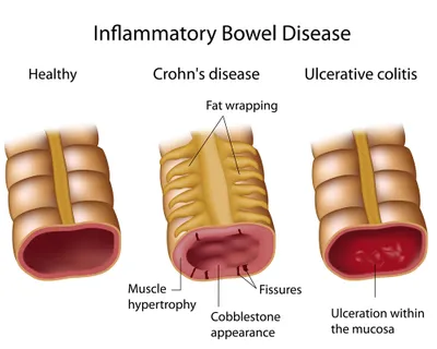 IBD