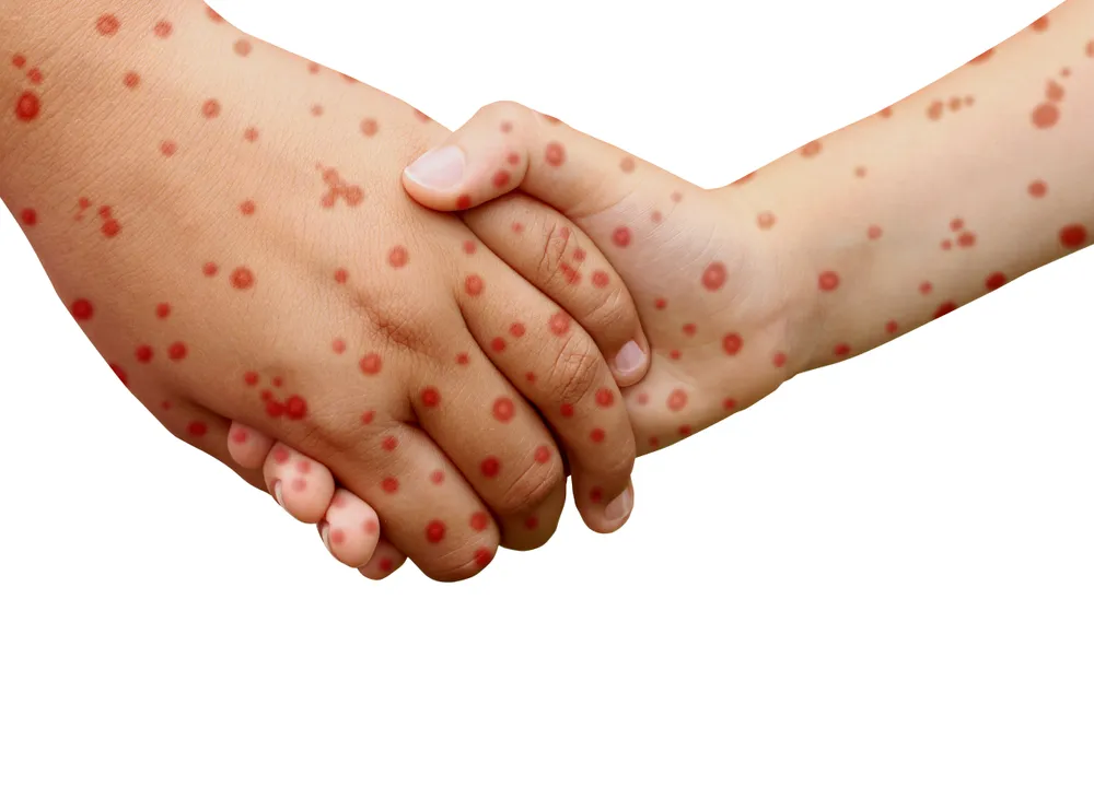 Is It Measles? Signs and Symptoms of Measles