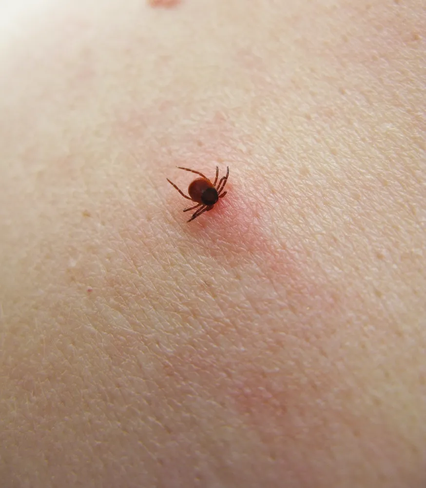 Los hechos y síntomas de la enfermedad de Lyme