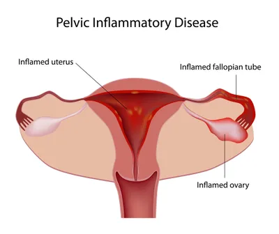 8 Causes Communes de Douleurs Pelviennes chez les Femmes ...