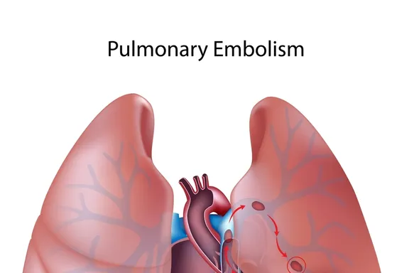 Consejos para vivir con Hipertensión Arterial Pulmonar