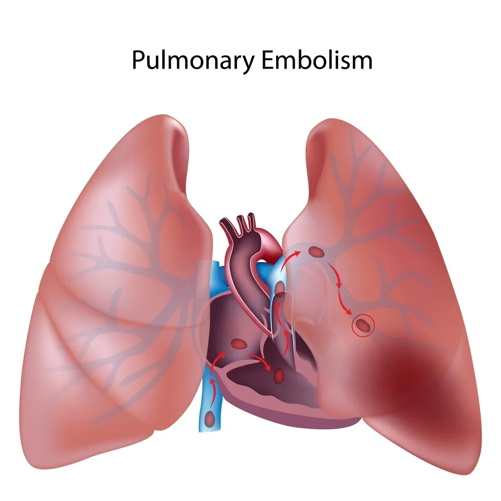 Consejos para vivir con Hipertensión Arterial Pulmonar