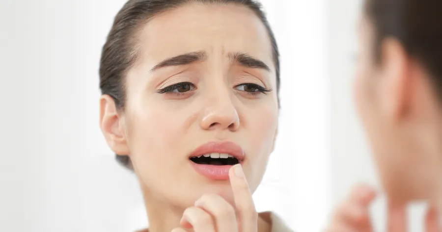 Razones por las que le salen herpes labiales