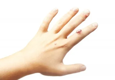 wart 10