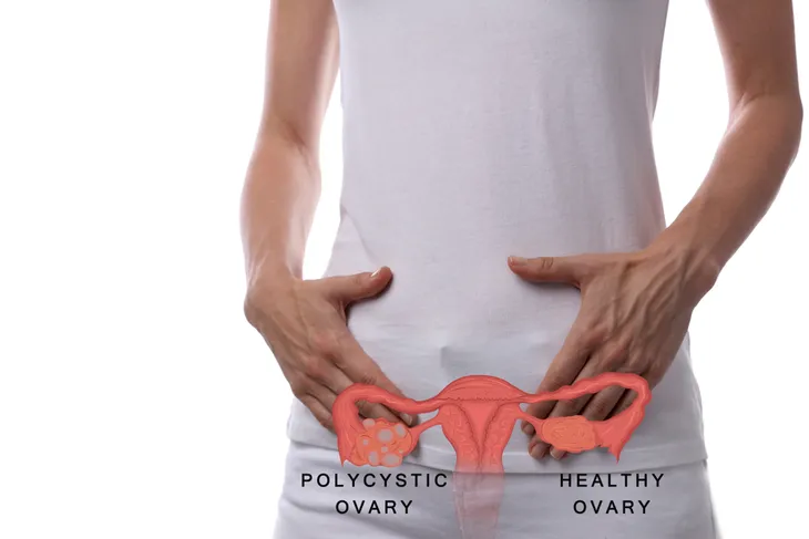 3 PCOS Cycle Patterns and What They Mean - PCOS Diva