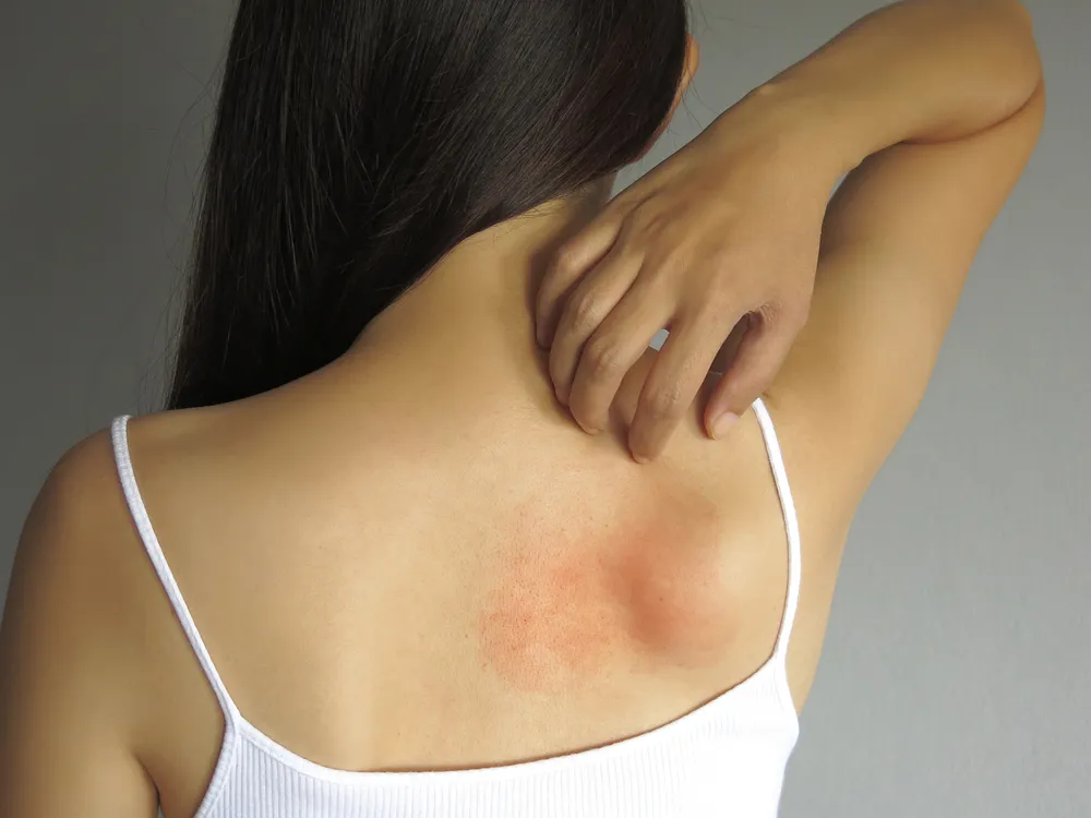Possible Causes of Irritating Skin Rashes