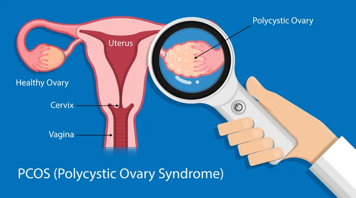 Important Facts on Polycystic Ovary Syndrome – ActiveBeat – Your Daily Dose  of Health Headlines